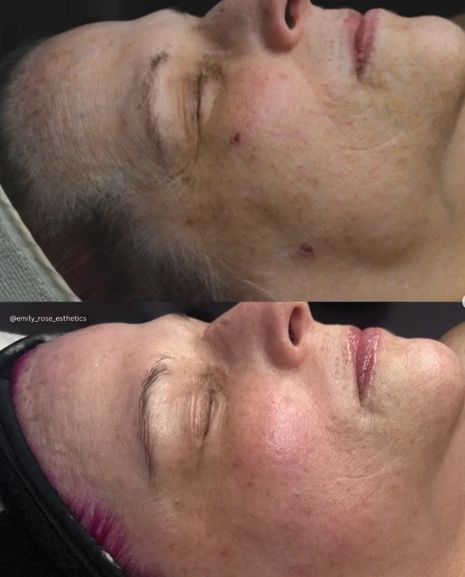 Side-by-side close-up of a person’s face before and after a skincare treatment, showing smoother skin and a more even complexion in the after image. - Jón Alan Salon in Nashville and Franklin, TN