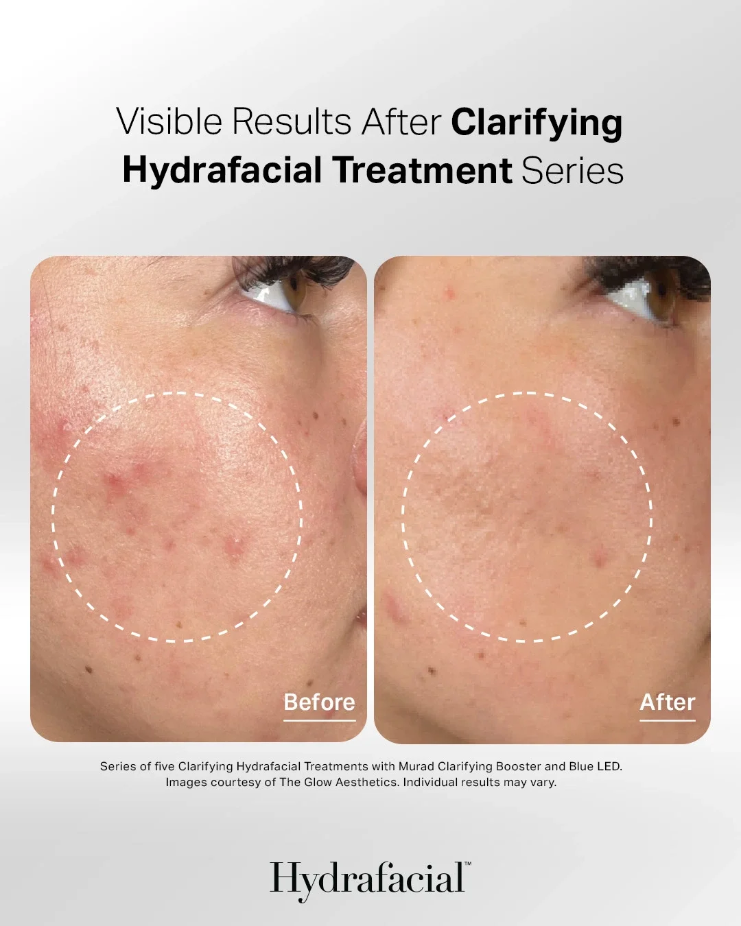 Close-up of a person’s cheek before and after a clarifying hydrafacial treatment, showing reduced redness and fewer blemishes in the “after” image. - Jón Alan Salon in Nashville and Franklin, TN