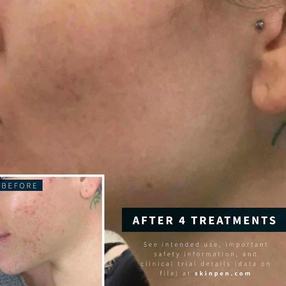Close-up of a person’s cheek showing smoother skin after 4 treatments, with a smaller ‘before’ inset highlighting previous redness and acne scars. Text detailing treatment appears on the image. - Jón Alan Salon in Nashville and Franklin, TN